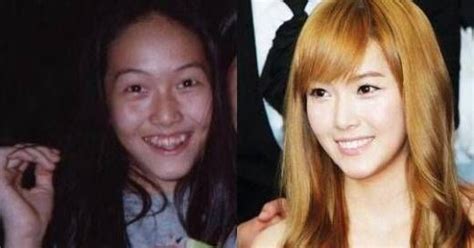 Kpop Female Idols Before And After Plastic Surgery Celebrity Plastic Surgery Plastic Surgery