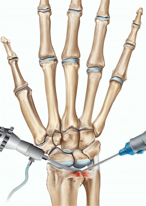 Ortho eval pal with paul marquis pt. Arthroscopie du poignet - Paris Clinique Docteur Gilles Cohen