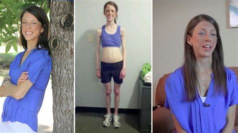 Severely Anorexic Woman S Life Saved By Worried Gym Goers Staging An Intervention World News