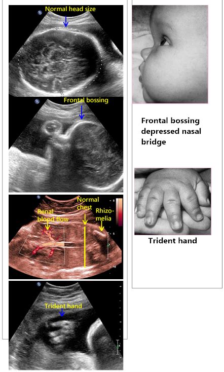 Frontal Bossing Ultrasound