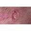 Basal Cell Carcinoma BCC  The London Dermatologist