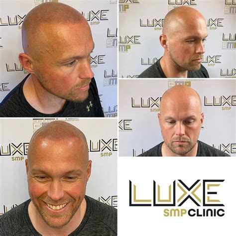 Male Pattern Baldness Receding Hairline And Hair Loss Treatment