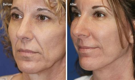 Radio Frequency Skin Tightening Does It Work And Is It Safe