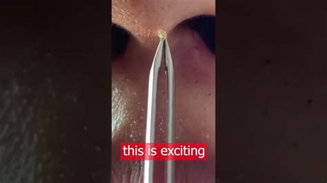 Pimple Popping New Blackheads On Nose Pimple Popping Tiktok