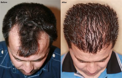 Fue Hair Restoration For Temple Recession Alviarmani Hair