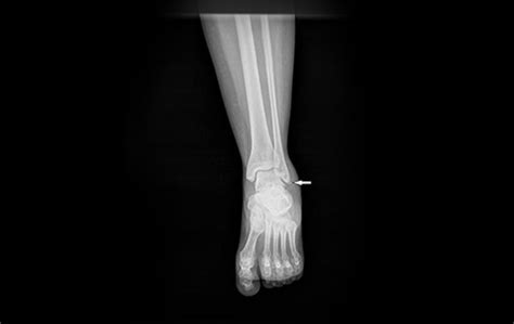 Avulsion Fracture Ankle Archives Journal Of Urgent Care Medicine