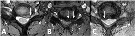 A Axial T2 Weighted Mri Showed Ventral Nerve Root Vnr Compression