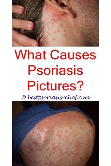 Psoriasiscauses Essential Oils For Psoriasis Of Scalp Doterra Does
