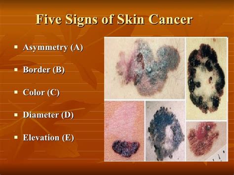 Signs Of Skin Cancer On Back