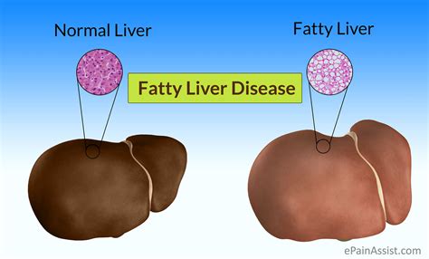 Herbal Remedies And Medicines For Fatty Liver Theayurveda