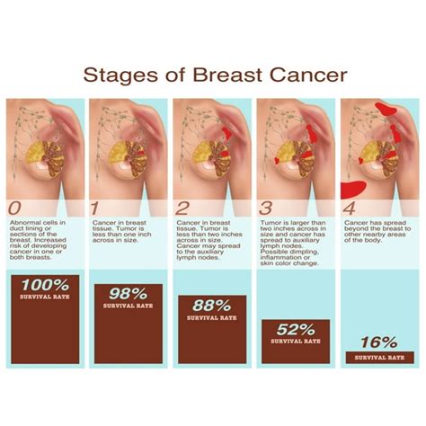 Breast Cancer Stages Illustration Poster Print By Gwen Shockeyscience Source 24 X 18 Walmart