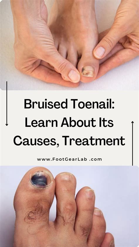 Bruised Toenail Learn About Its Causes Treatment And Prevention Artofit