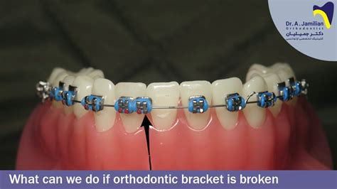 What Can We Do If Orthodontic Bracket Is Broken Dr Jamilian