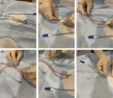 Pop The Balloon Rapid Switch From Intra‐aortic Balloon Pump To