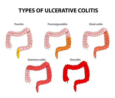 Ulcerative Colitis Doctors Piedmont Colorectal Specialists