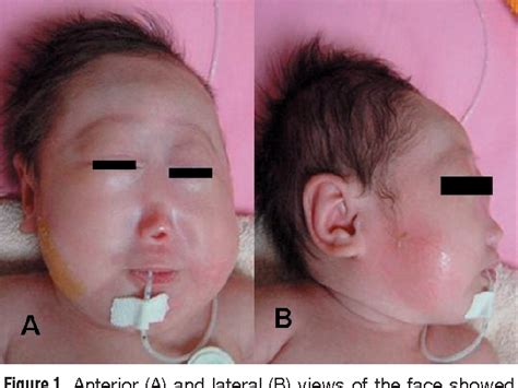 Holoprosencephaly Hpe What It Is Causes Types 46 Off