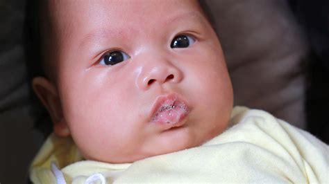 Baby Drool Rash Causes Appearance And Treatment Gladskin