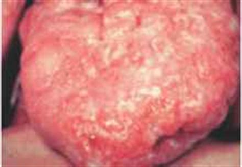 Detecting cancer in its early stages increases the likelihood that you'll be able to successfully treat it. Other precancerous conditions - Squamous Cell - ALPF ...