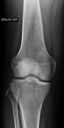 Tibial Plateau Fracture Radiology Case Radiopaedia Org
