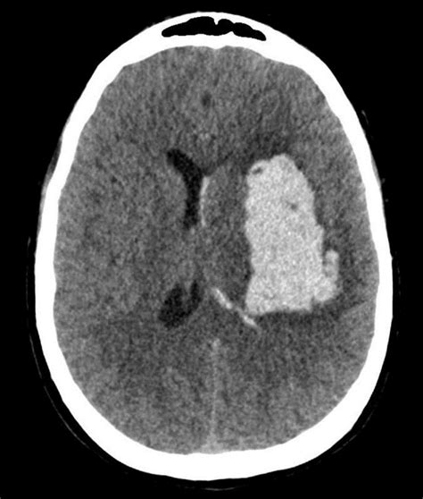 They are essential component of. Intracerebral Hemorrhage Removal with Endoscopic Side ...