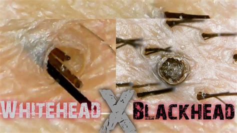 Blackhead And Whitehead On The Scalpsatisfying Extractionclose Up