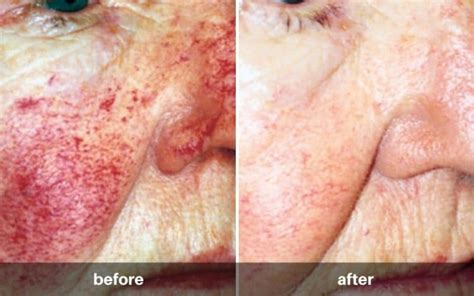 Rosacea Treat Burning Irritation And Redness Skin Conditions