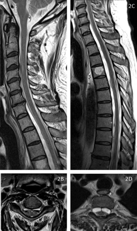 Bibrachial Amyotrophy And Ventral Spinal Cyst Associated With