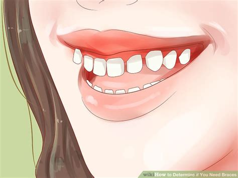 However, there will probably be an adjustment period needed to get used to the feeling. How to Determine if You Need Braces (with Pictures) - wikiHow