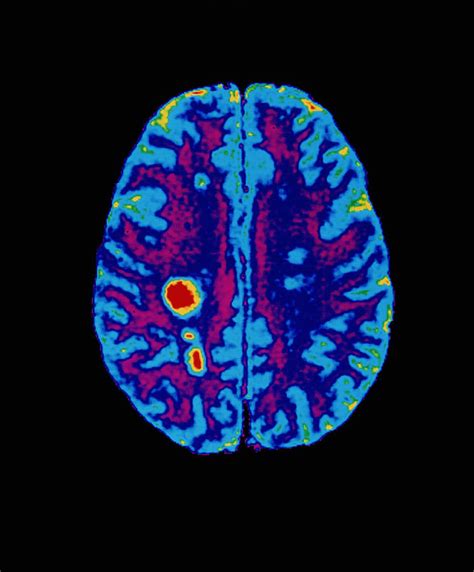 Col Mri Scan Of A Brain With Multiple Sclerosis Photograph By Pixels