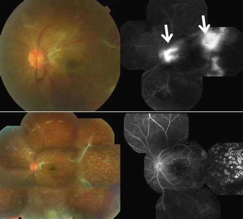 Fundus Photographs And Fluorescein Angiographs Of Case 1 A Fundus
