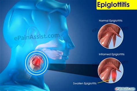 💊 Epiglotitis Causas Síntomas Y Diagnóstico 2020