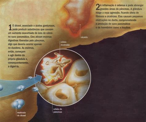 La pancreatite cronica è una condizione medica definita dalla presenza di un'infiammazione duratura, persistente e permanente a carico del pancreas. Pancreatite | Wiki AIA 13-17 | FANDOM powered by Wikia