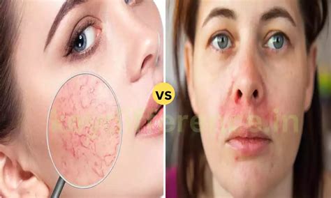 What Is The 7 Difference Between Perioral Dermatitis And Rosacea Key