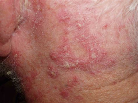 Seborrheic Dermatitis Charlie Goldberg M D Ucsd Grepmed