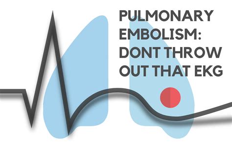 Pulmonary Embolism Dont Throw Out That Ekg — Nuem Blog