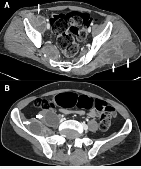 Follow Up Ct Abdomen And Pelvis Axial Section Of The Patient The
