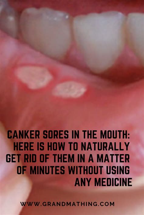 Canker Sores In The Mouth Here Is How To Naturally Get Rid Of Them In