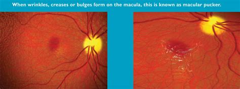Macular Pucker Rand Eye Institute