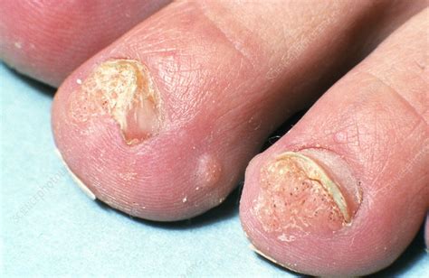 Warts On Young Mans Toes Stock Image M2900070 Science Photo Library