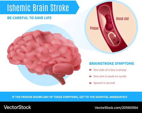 Ischemic Brain Stroke Poster Royalty Free Vector Image