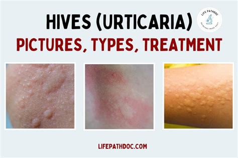Hives Urticaria Pictures Types Causes And Treatment