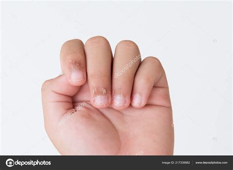 Close Childs Fingers Dry Skin Eczema Dermatitis Medicine Health Care