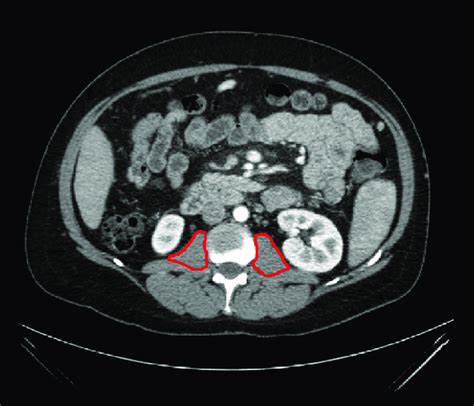 Cross Section Of Patient Ct Scan At L2l3 With Bilateral Psoas Muscle