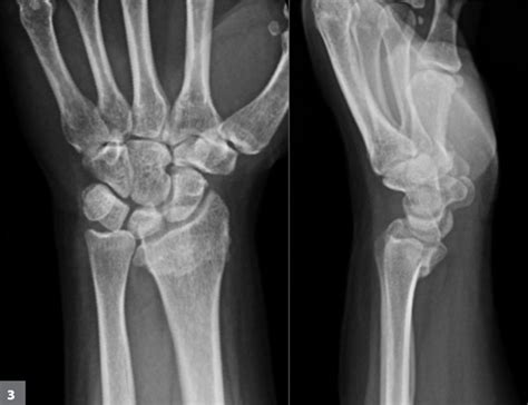 50 Year Old Woman With Ulnar Sided Wrist Pain
