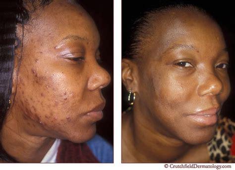 Acne Laser Treatment On Dark Skinned Woman Before And After A Photo On Flickriver