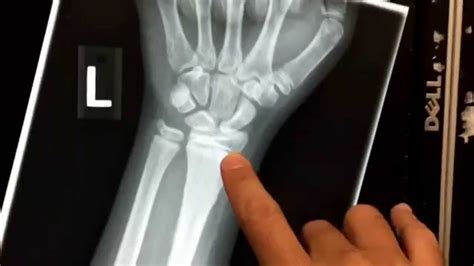 Wrist X Ray In A Child Youtube