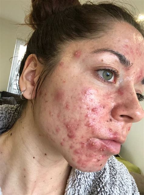 Woman 25 Has To Quit Job As Boils Erupt In Worst Case Of Acne Docs Have Seen Mirror Online