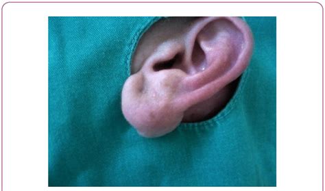 Tumor In The Left Ear Lobe Download Scientific Diagram