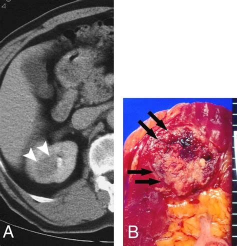 A 69 Year Old Man With Collecting Duct Carcinoma Of The Kidney A Ct