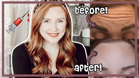 Botox At 24 Before And After Cost My Experience Moriah Robinson